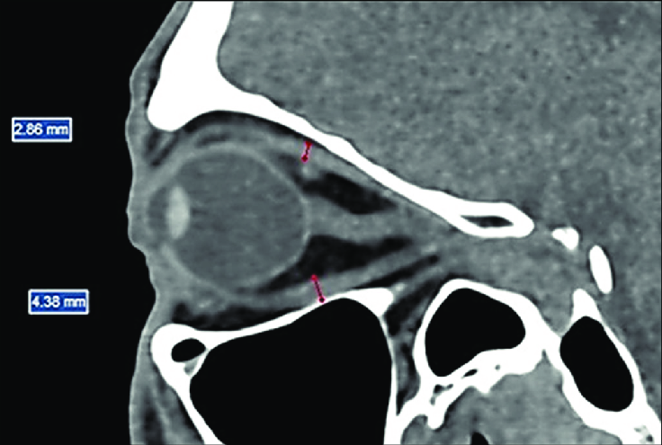 Anatomia da órbita em TC