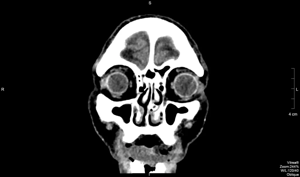 Anatomia da órbita em TC