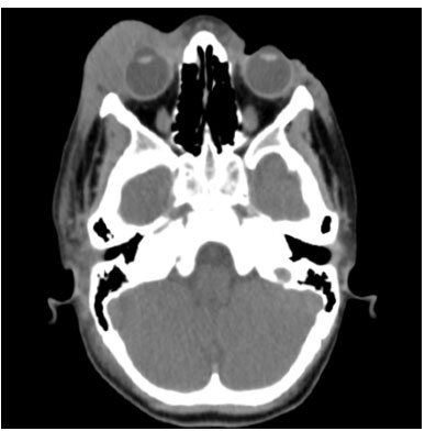 Celulite  órbital em TC