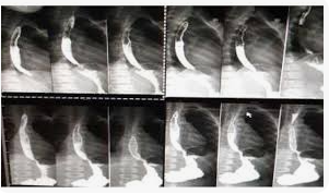 Esôfago em diferentes projeções