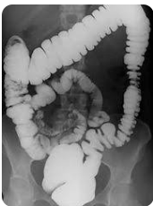 Enema opaco com duplo contraste