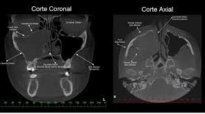Ilustração dos Seios Paranasais