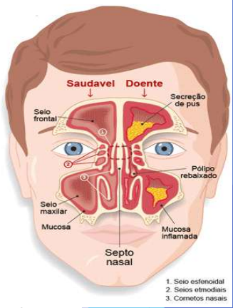 Ilustração dos Seios Paranasais