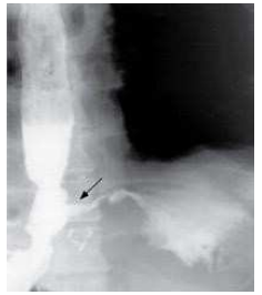 Perfuração esofágica