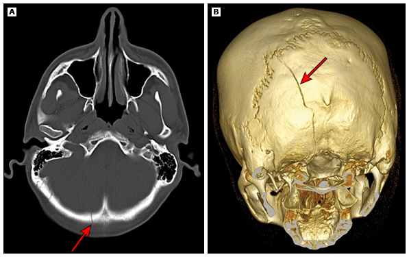 Fratura de crânio em TC