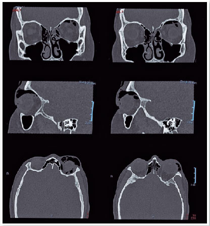 Fratura de órbita em TC