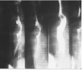 Leiomioma esofágico