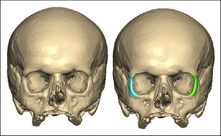 Reconstrução 3D de órbita