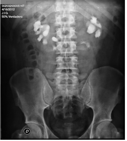 UIV com Rim em Ferradura