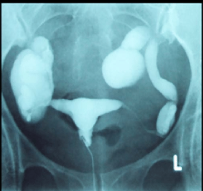 Imagem de Hidrossalpinge