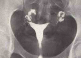 HSG Normal com Espalhamento Bilateral