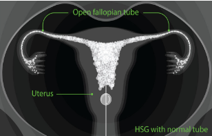 HSG Normal com Espalhamento Bilateral