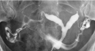 HSG Normal com Espalhamento Bilateral