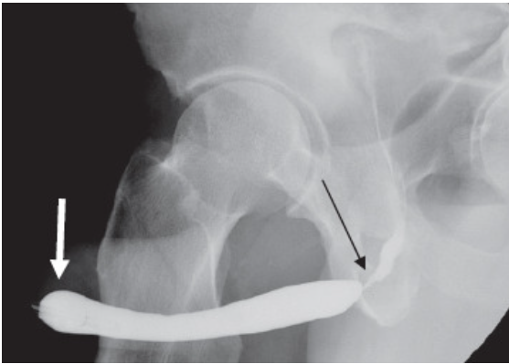 Imagem de Estenose Uretral