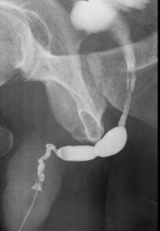 Imagem de Estenose Uretral