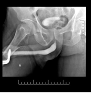 Imagem de Estenose Uretral