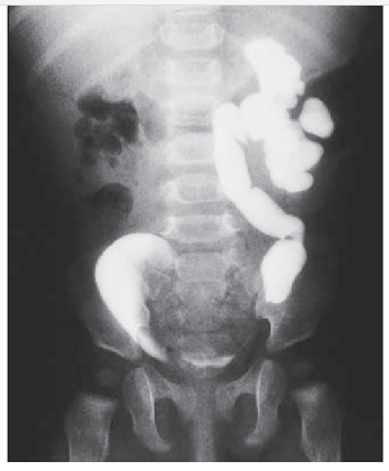 UIV com Cálculo Obstrutivo