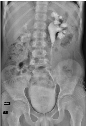 UIV com Cálculo Obstrutivo