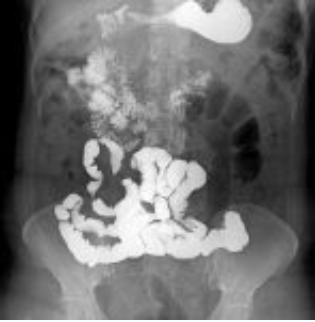 Trânsito intestinal com bário